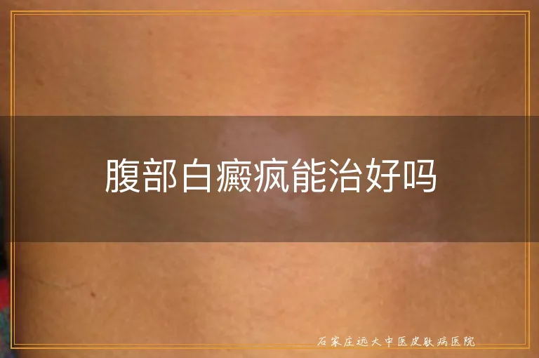 腹部白癜疯能治好吗