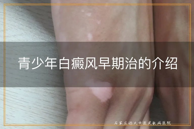 青少年白癜风早期治的介绍