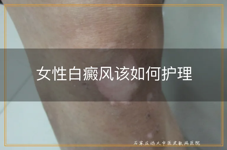 女性白癜风该如何护理