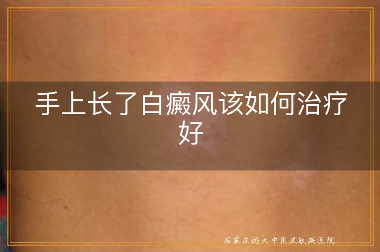 手上长了白癜风该如何治疗好