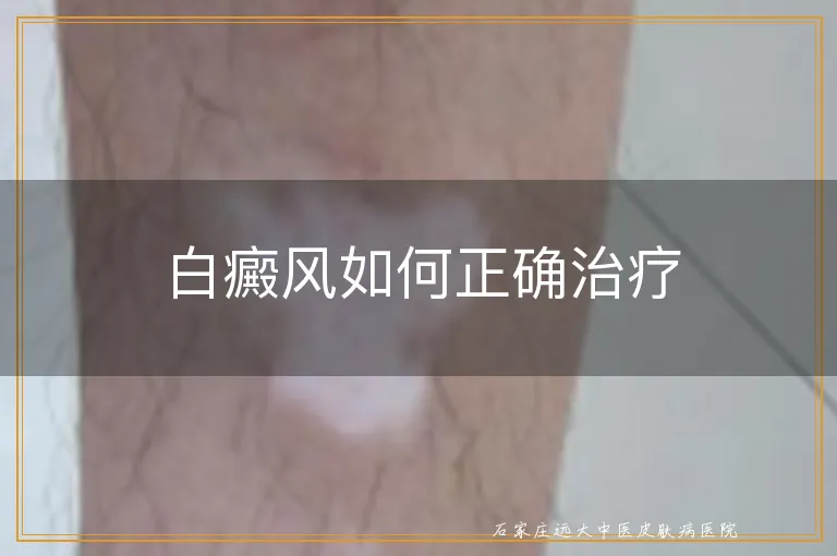 白癜风如何正确治疗