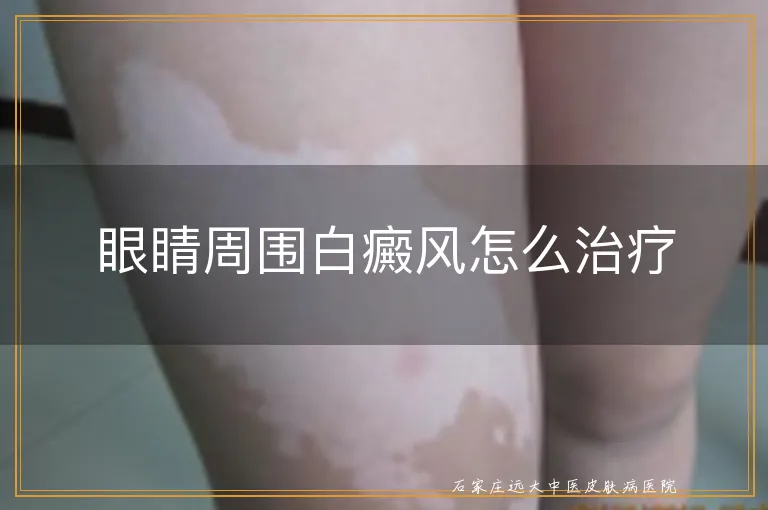 眼睛周围白癜风怎么治疗