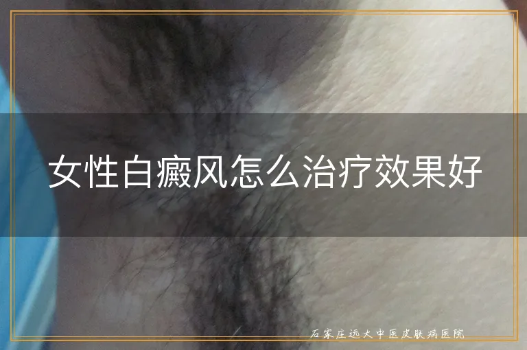 女性白癜风怎么治疗效果好