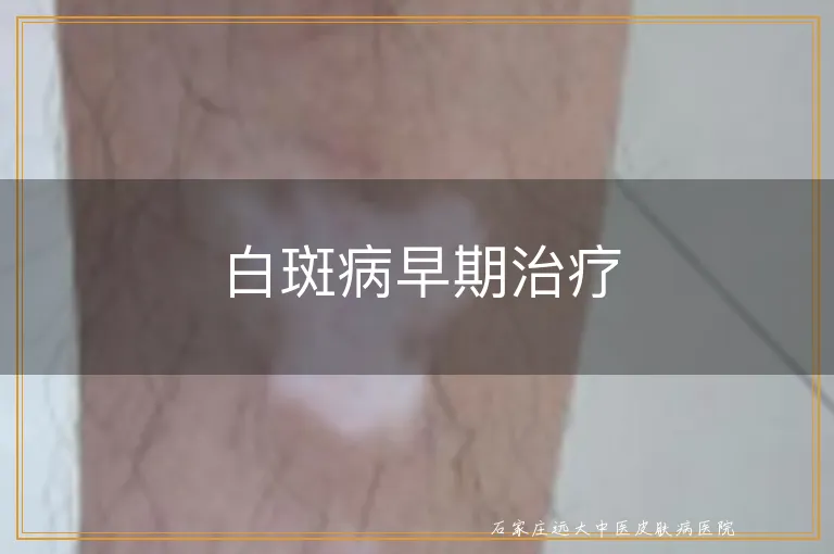 白斑病早期治疗