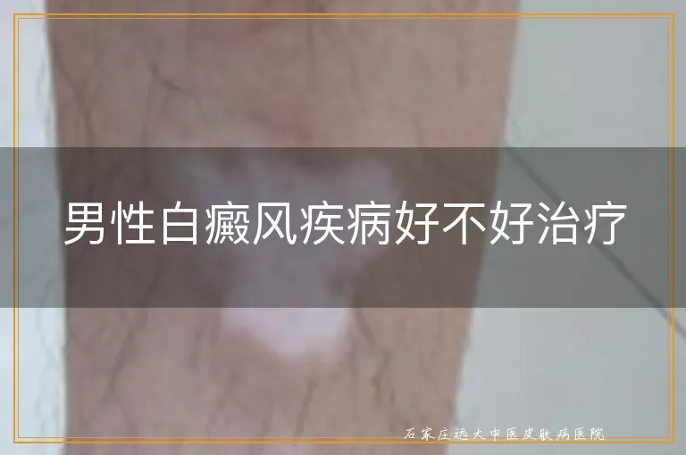 男性白癜风疾病好不好治疗