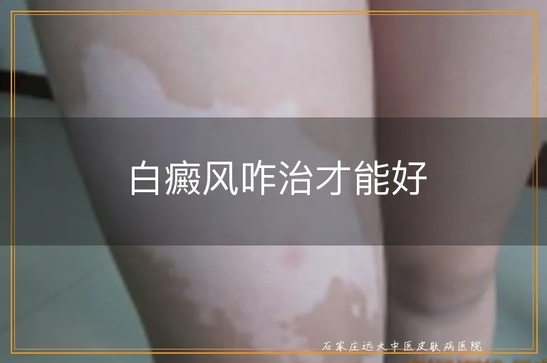 白癜风咋治才能好