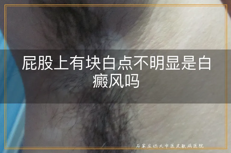 屁股上有块白点不明显是白癜风吗