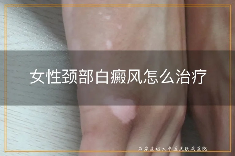 女性颈部白癜风怎么治疗