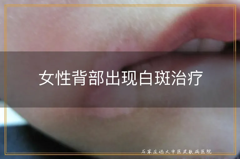 女性背部出现白斑治疗