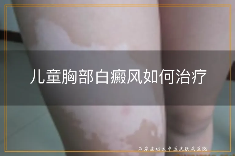 儿童胸部白癜风如何治疗