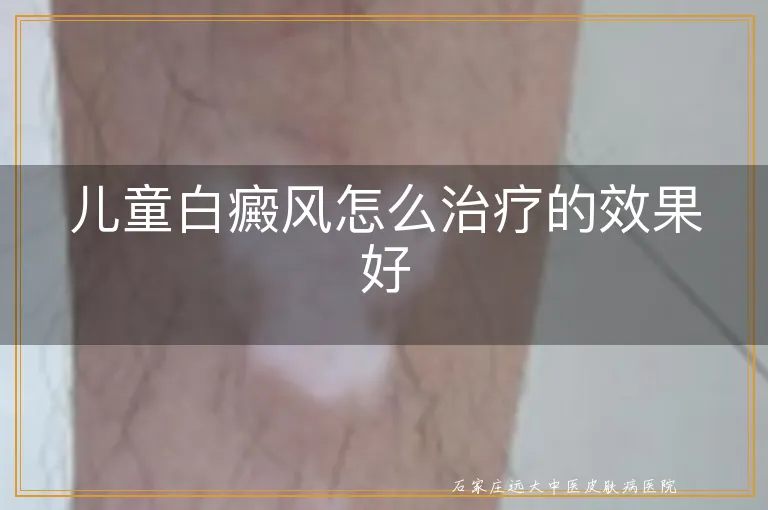 儿童白癜风怎么治疗的效果好