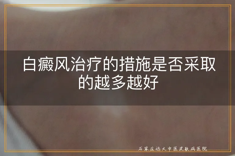 白癜风治疗的措施是否采取的越多越好