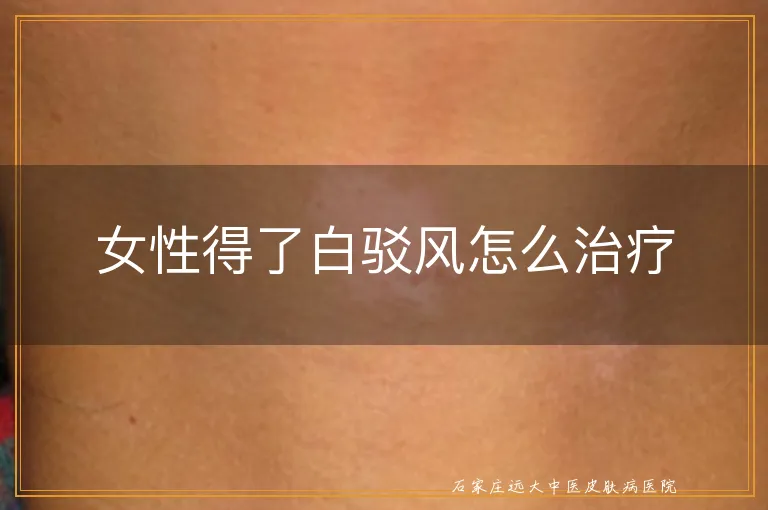 女性得了白驳风怎么治疗