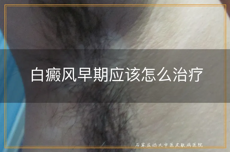 白癜风早期应该怎么治疗