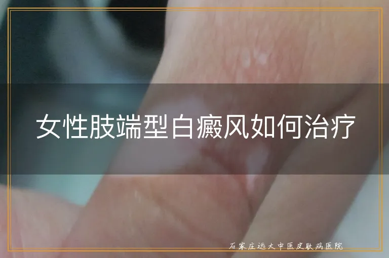 女性肢端型白癜风如何治疗