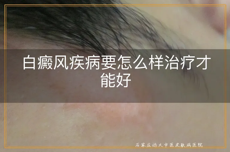 白癜风疾病要怎么样治疗才能好