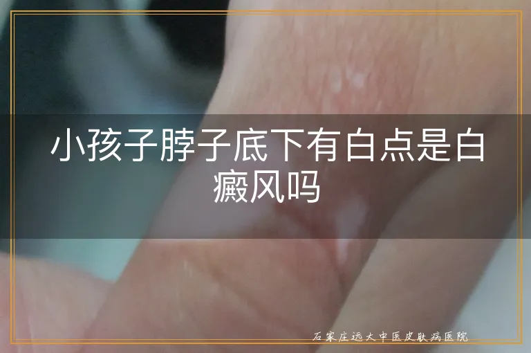 小孩子脖子底下有白点是白癜风吗