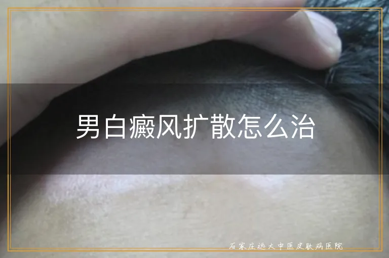 男白癜风扩散怎么治