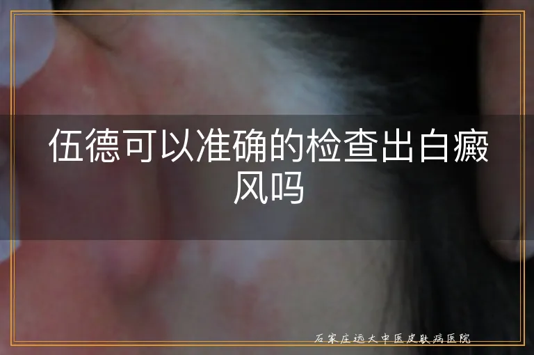 伍德可以准确的检查出白癜风吗