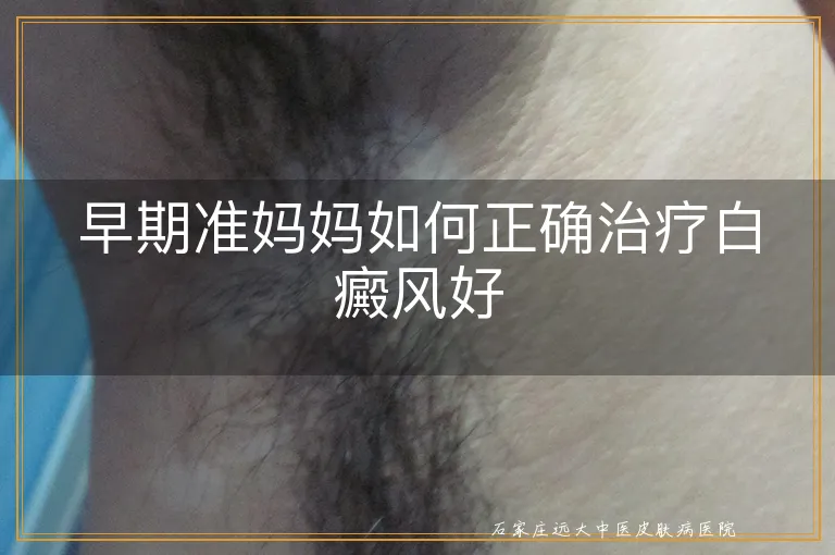 早期准妈妈如何正确治疗白癜风好