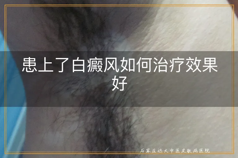 患上了白癜风如何治疗效果好