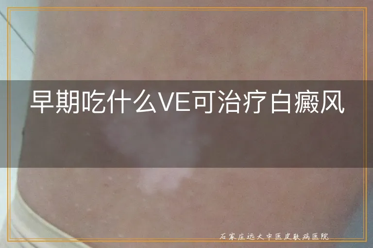 早期吃什么VE可治疗白癜风