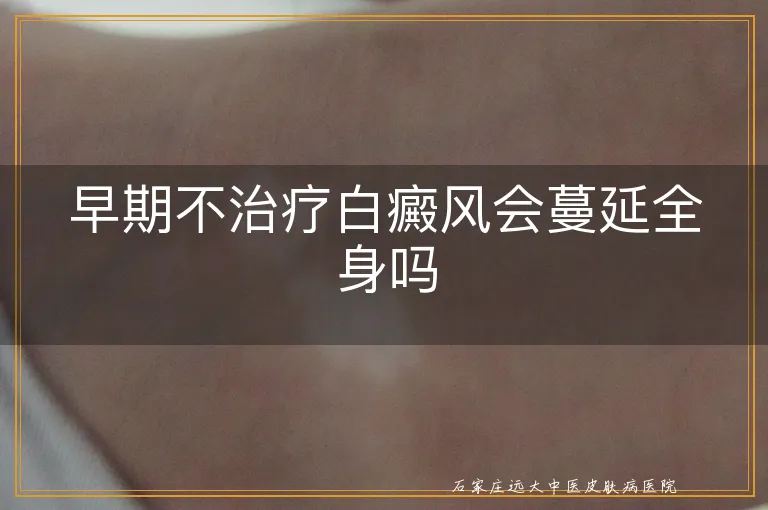 早期不治疗白癜风会蔓延全身吗