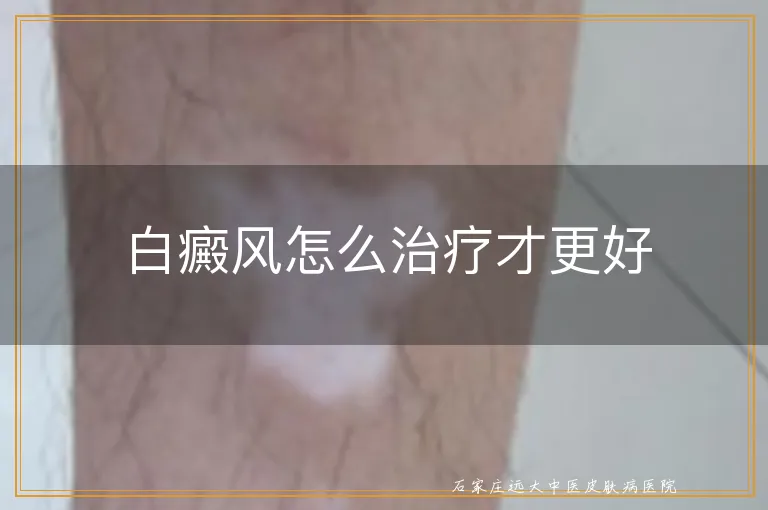 白癜风怎么治疗才更好