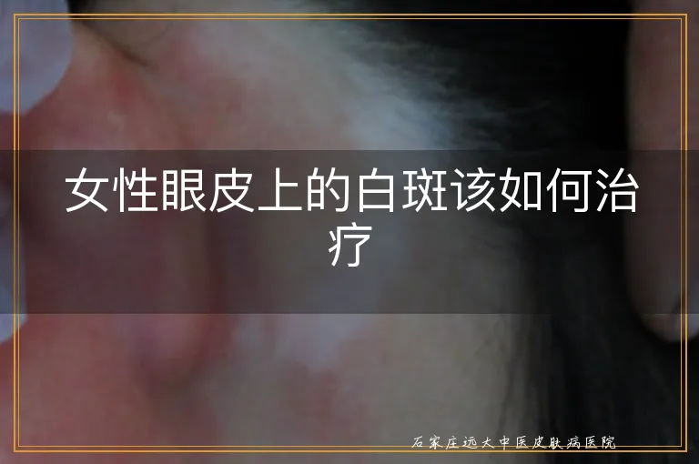 女性眼皮上的白斑该如何治疗