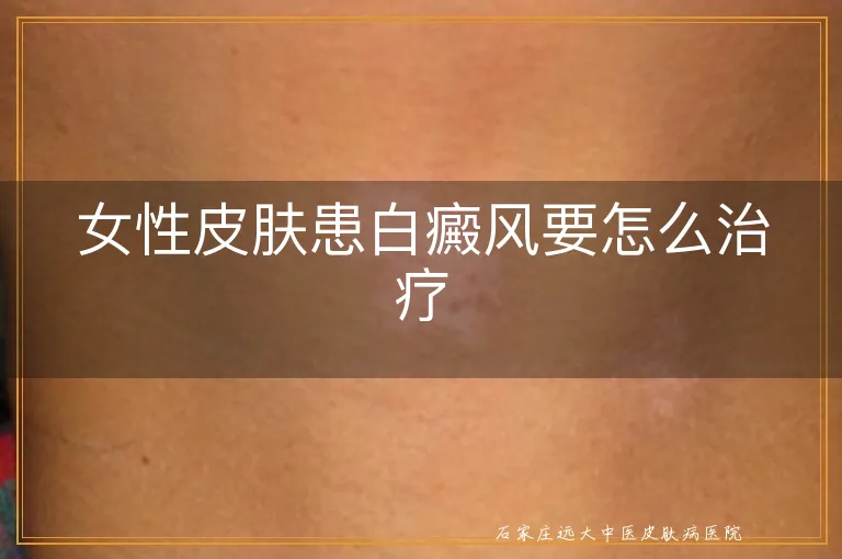 女性皮肤患白癜风要怎么治疗