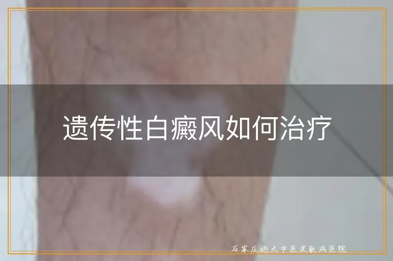 遗传性白癜风如何治疗