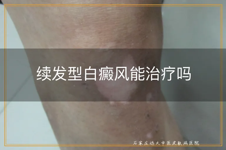 续发型白癜风能治疗吗