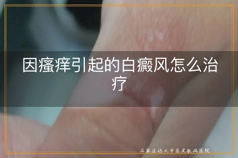 因瘙痒引起的白癜风怎么治疗