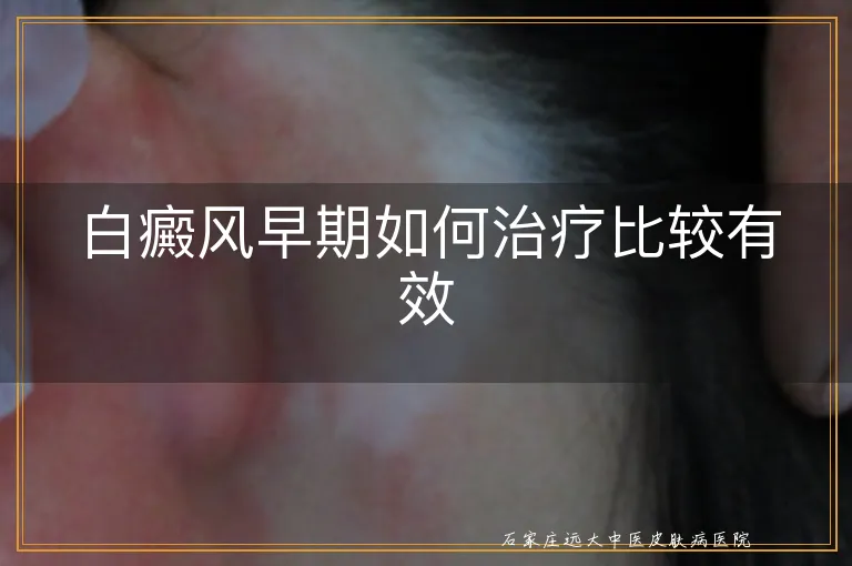 白癜风早期如何治疗比较有效