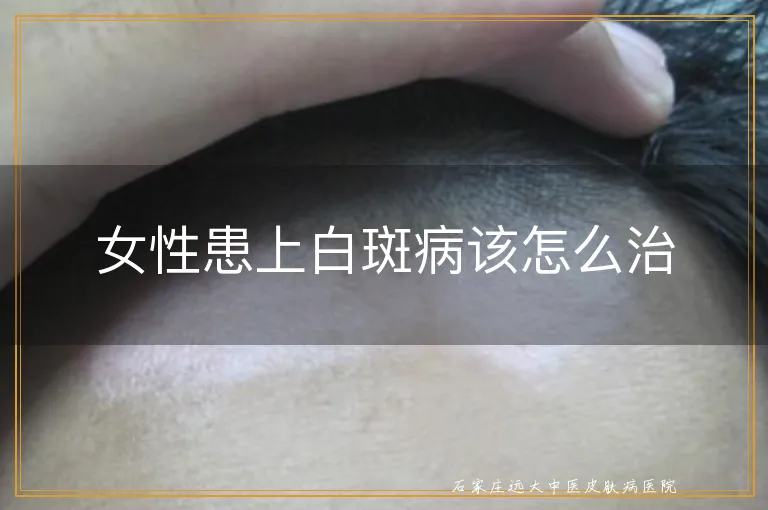 女性患上白斑病该怎么治