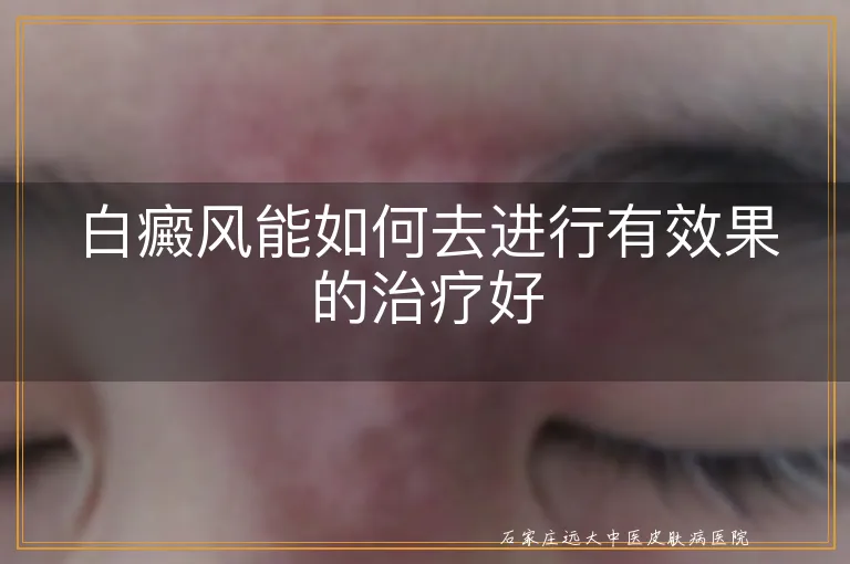 白癜风能如何去进行有效果的治疗好