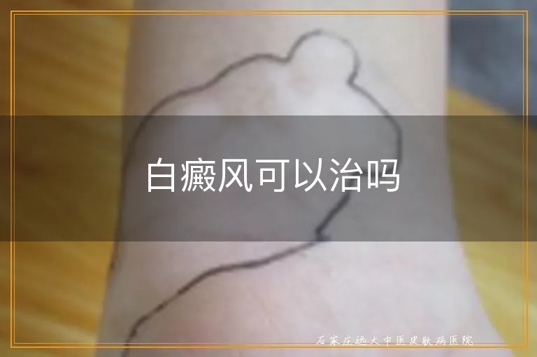 白癜风可以治吗