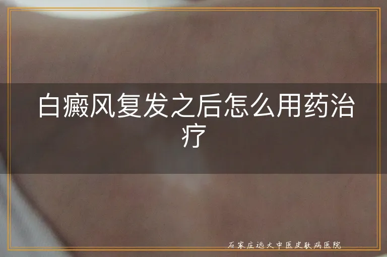 白癜风复发之后怎么用药治疗