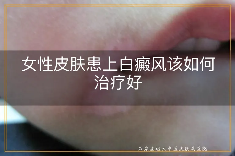 女性皮肤患上白癜风该如何治疗好