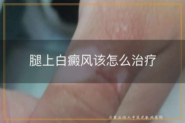 腿上白癜风该怎么治疗