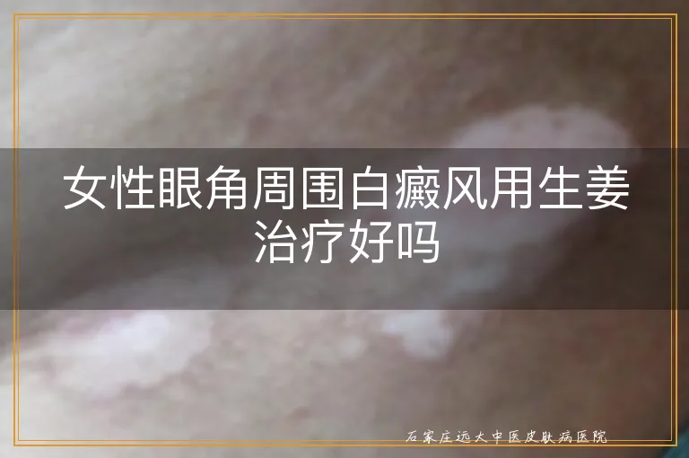 女性眼角周围白癜风用生姜治疗好吗