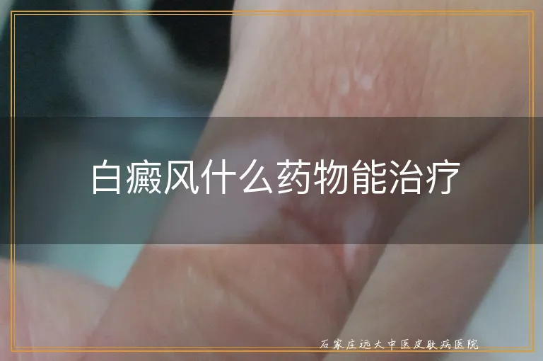 白癜风什么药物能治疗