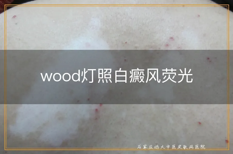 wood灯照白癜风荧光