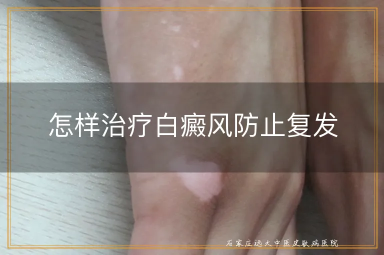 怎样治疗白癜风防止复发