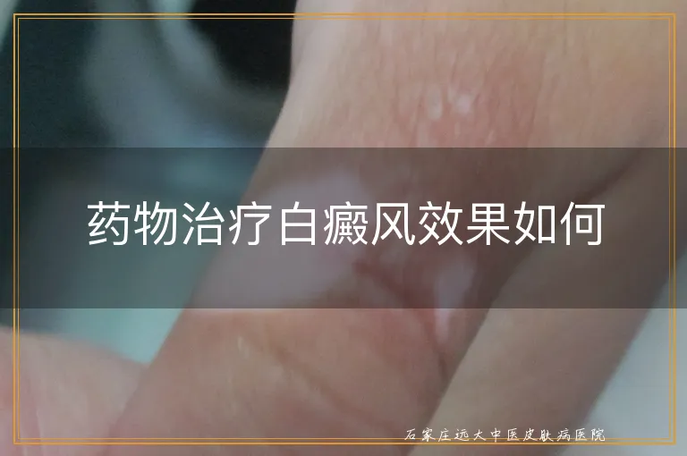 药物治疗白癜风效果如何