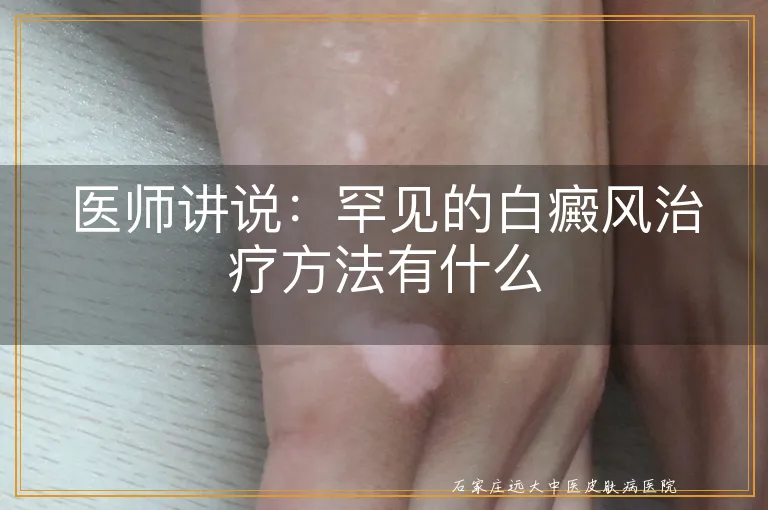 医师讲说：罕见的白癜风治疗方法有什么