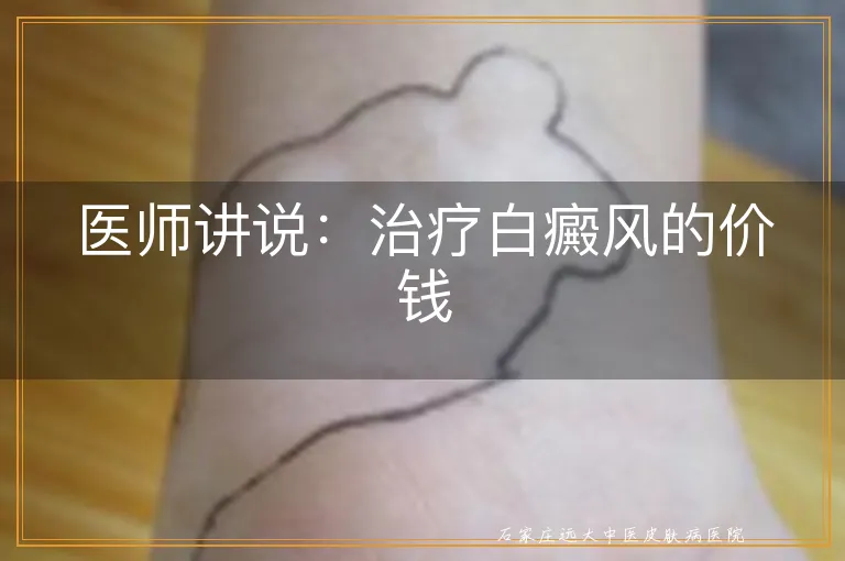 医师讲说：治疗白癜风的价钱