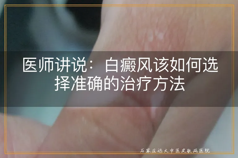 医师讲说：白癜风该如何选择准确的治疗方法