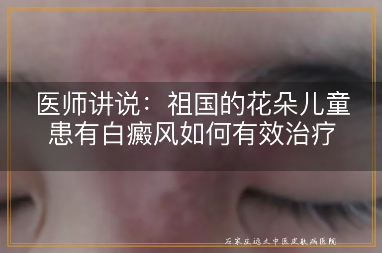 医师讲说：祖国的花朵儿童患有白癜风如何有效治疗