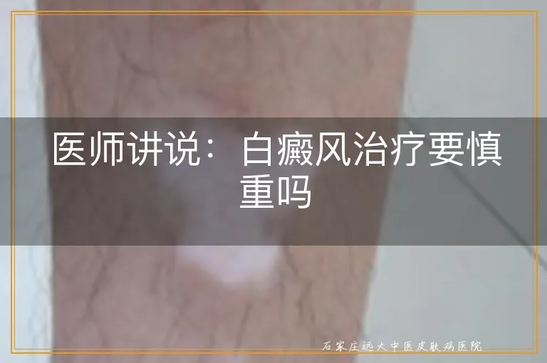 医师讲说：白癜风治疗要慎重吗